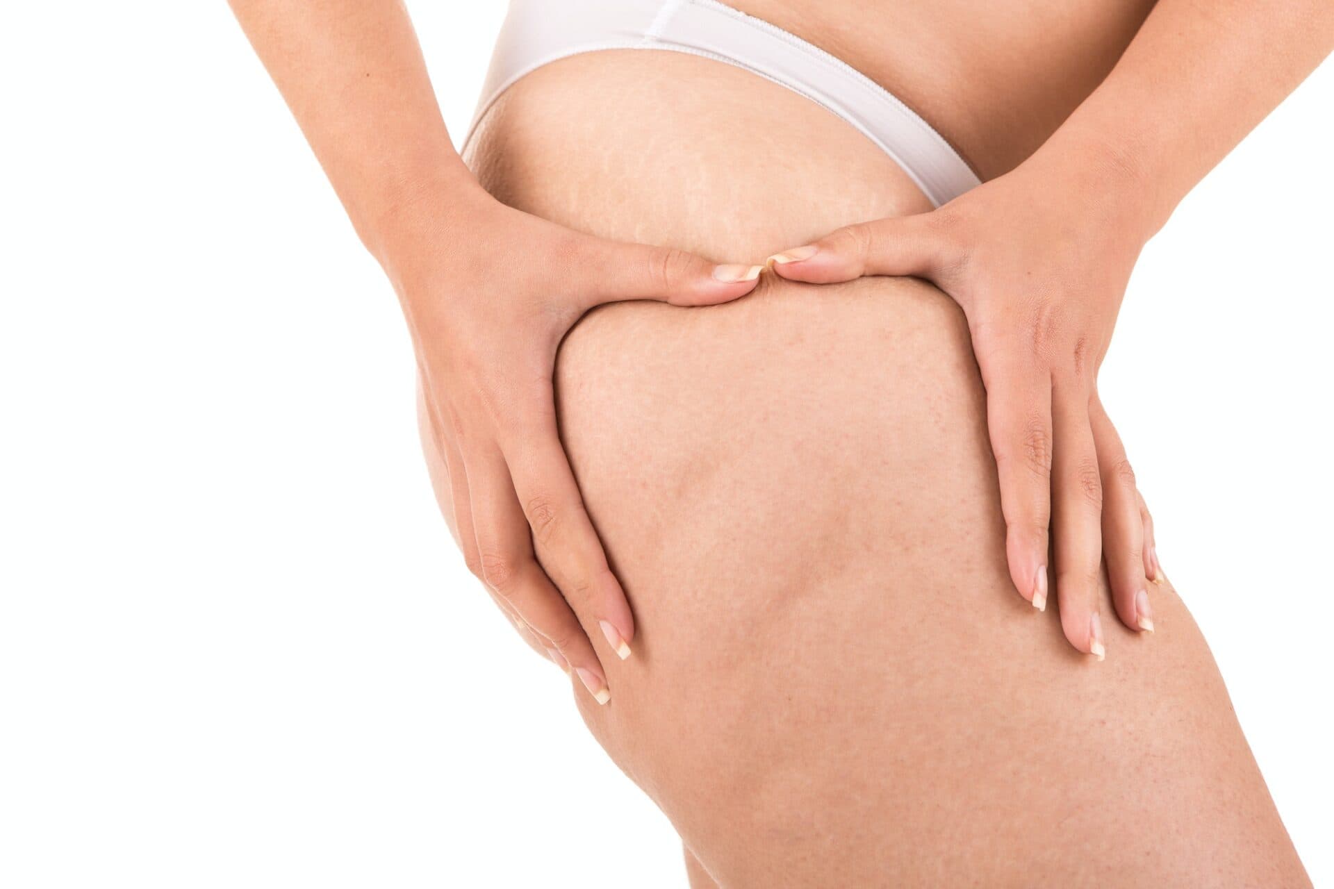Why do we get cellulite?